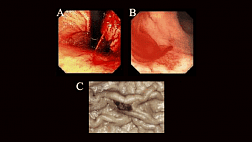 Повреждение Делафуа