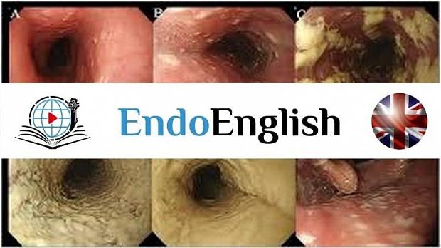 esophageal candidiasis