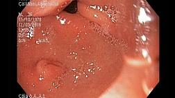 Аберрантная (эктопическая) поджелудочная железа в антральном отделе желудка