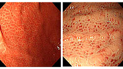 Гастрит или гастропатия? Лекция