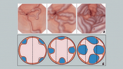 РОЛЬ ЛИГИРОВАНИЯ ВАРИКОЗНО-РАСШИРЕННЫХ ВЕН ПИЩЕВОДА В ПРОФИЛАКТИКЕ КРОВОТЕЧЕНИЙ ПОРТАЛЬНОГО ГЕНЕЗА
