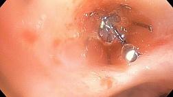 ИСПОЛЬЗОВАНИЕ ФИБРИНОВОГО КЛЕЯ ПРИ ОСТАНОВКЕ КРОВОХАРКАНЬЯ