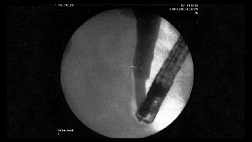 Баллонная дилатация сфинктера Одди