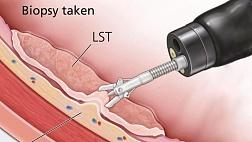 Биопсия при выполнении эндоскопических исследований верхних отделов пищеварительного тракта. Обзор.