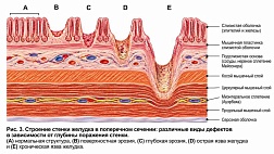 Классификация эрозий желудка по Тольямо (Toljamo), 2012