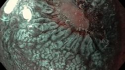 Эндоскопические признаки кишечной метаплазии