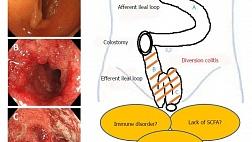 ДИВЕРСИОННЫЙ КОЛИТ
