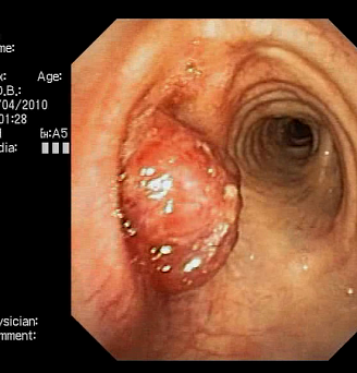 Нейроэндокринная опухоль левого главного бронха.. Атлас эндоскопических изображений endoatlas