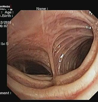 Трахеоскопия. Синдром Мунье-Куна. Атлас эндоскопических изображений endoatlas