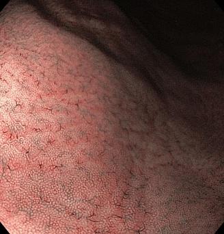 Номальная слизистая желудка . Атлас эндоскопических изображений endoatlas