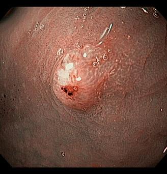 Аденокарцинома in situ прямой кишки.jpg. Атлас эндоскопических изображений endoatlas