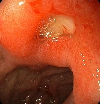 Хроническая язва луковицы 12-перстной кишки. Атлас эндоскопических изображений endoatlas