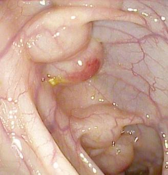 Кистозный пневматоз. Атлас эндоскопических изображений endoatlas