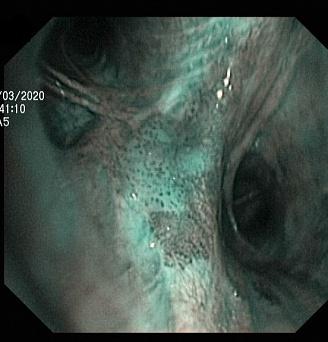ранний центральный рак нижней доли левого легкого.. Атлас эндоскопических изображений endoatlas