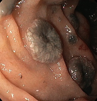 Метастаз пигментной меланомы ДПК. Атлас эндоскопических изображений endoatlas