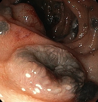 Метастаз пигментной меланомы двенадцатиперстной кишки. Атлас эндоскопических изображений endoatlas