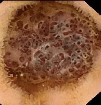 Кавернозная гемангиома тощей кишки. Атлас эндоскопических изображений endoatlas