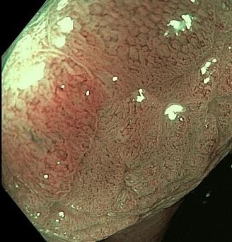 Тубулярная аденома с дисплазией железистого эпителия высокой степени.. Атлас эндоскопических изображений endoatlas