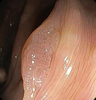 Зубчатая аденома ободочной кишки.. Атлас эндоскопических изображений endoatlas