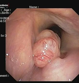 Опухоль гортани. Атлас эндоскопических изображений endoatlas
