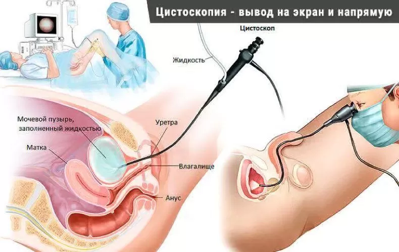 Видео: лазерное омоложение влагалища (лазерная вагинопластика)