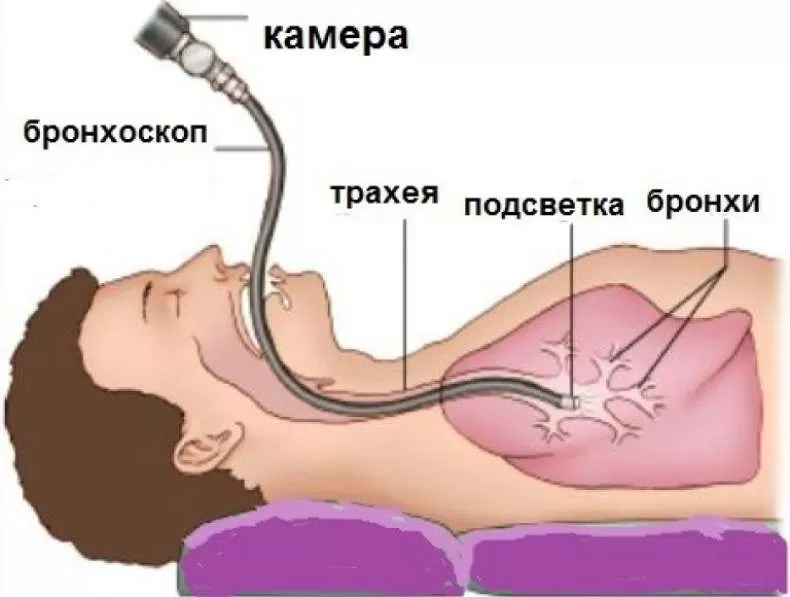 Центральный рак легкого - презентация