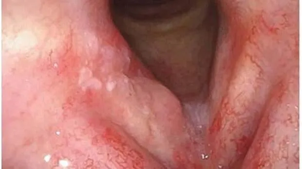 Papilloma sinus b2