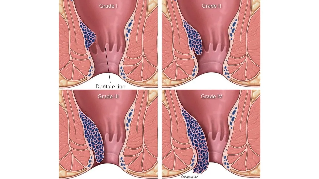 Клиническая классификация геморроя - стадии по степеням