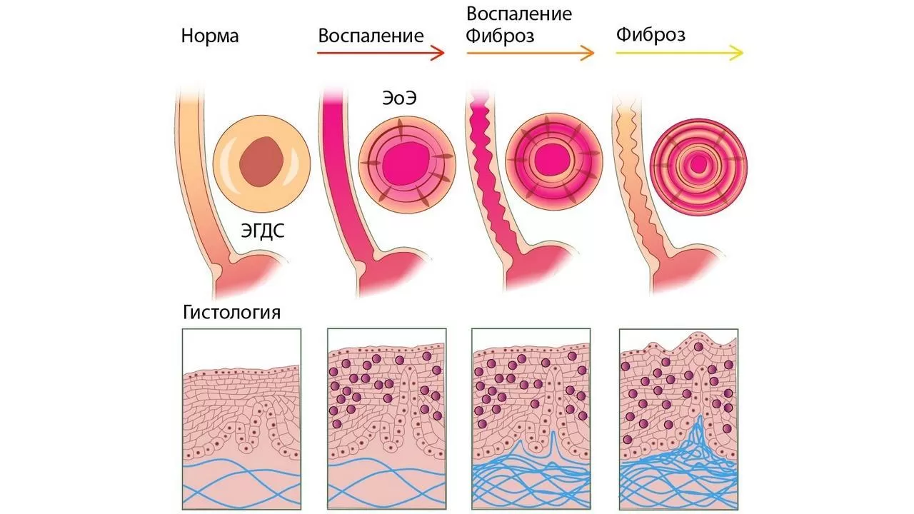 ЭОЗИНОФИЛЬНЫЙ ЭЗОФАГИТ - астма пищевода?