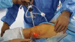 Эндоскопия коленного сустава