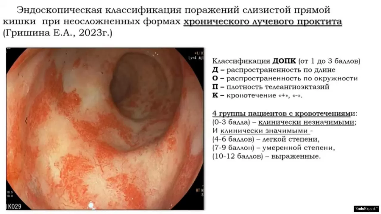 ДОПК - Эндоскопическая классификация поражений слизистой прямой кишки при  неосложненных формах хронического лучевого проктита Гришина Е.А., 2023г.