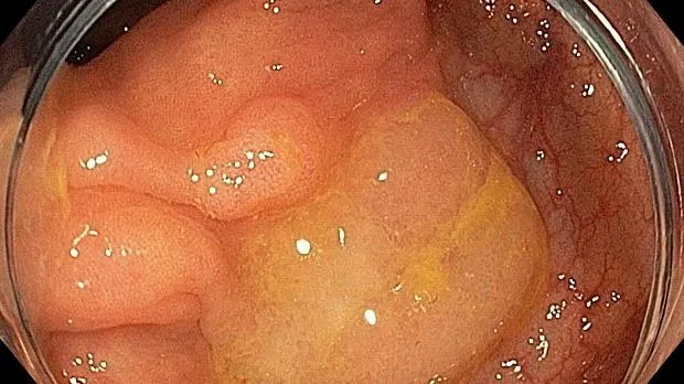 Удаление эпителиальных образований (полипов и стелющихся опухолей) желудка и толстой кишки
