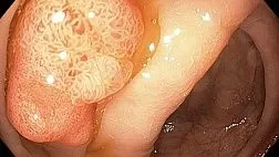 Аденокарцинома на фоне аденоматозного полипа сигмовидной кишки