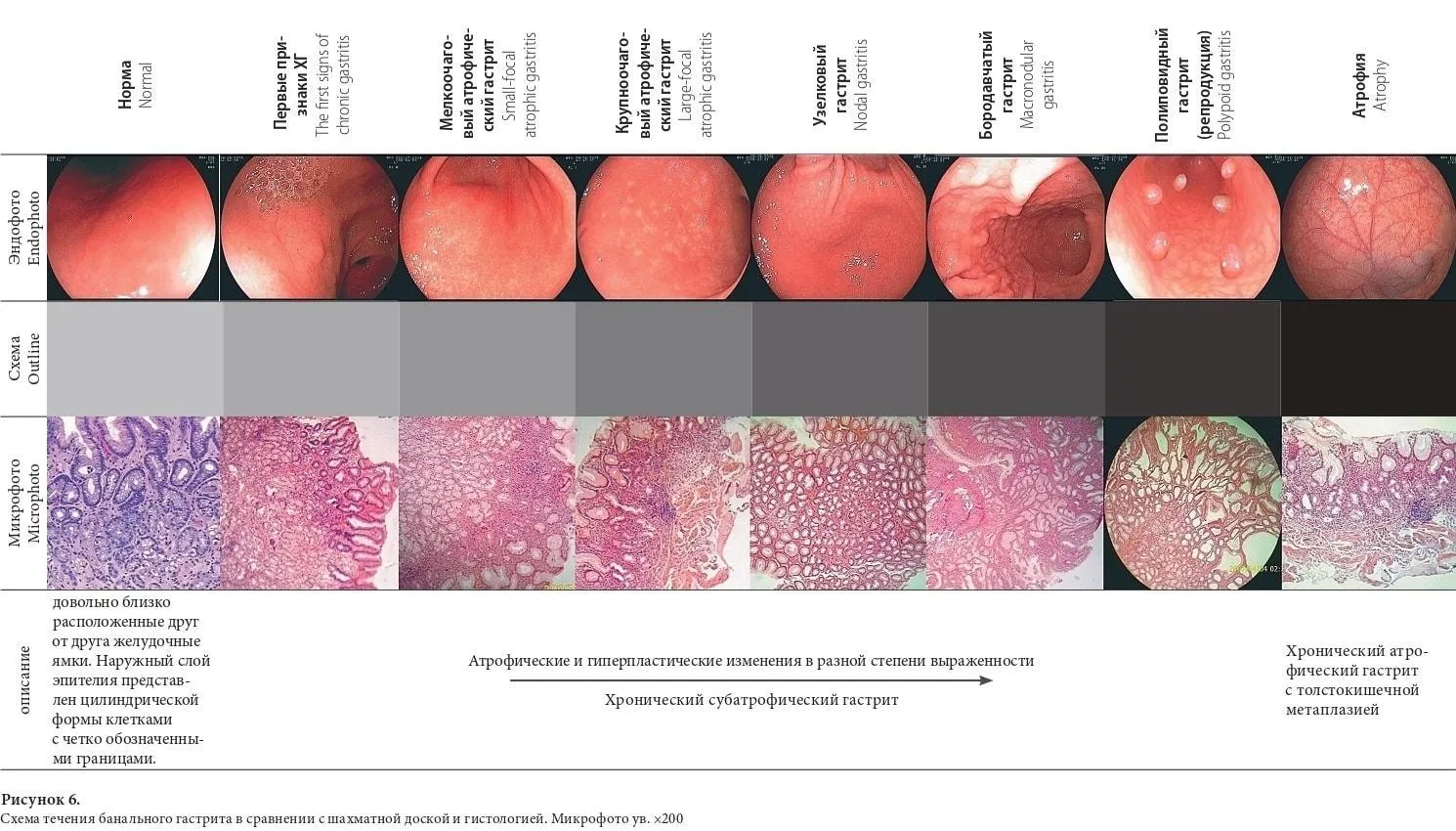 Современная классификация хронического гастрита - виды, понятие,  клиническая значимость