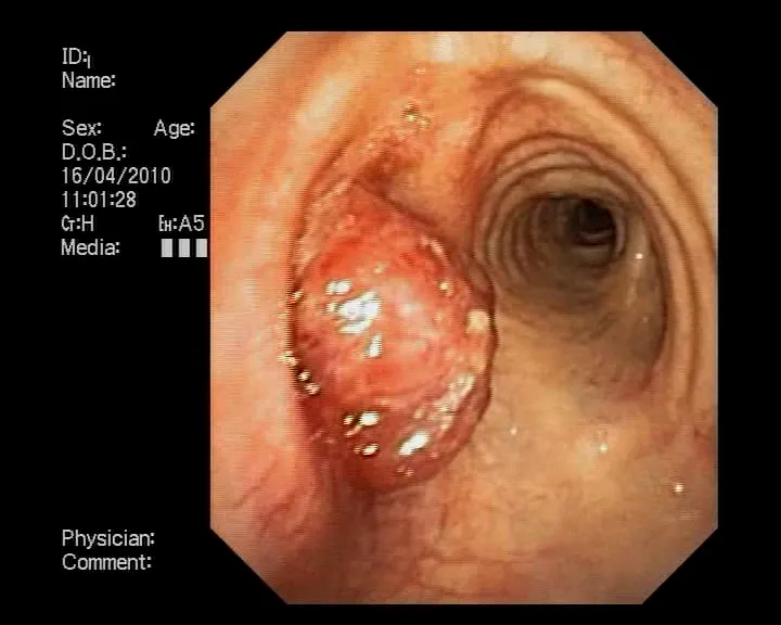 Нейроэндокринная опухоль левого главного бронха.. Атлас эндоскопических изображений endoatlas
