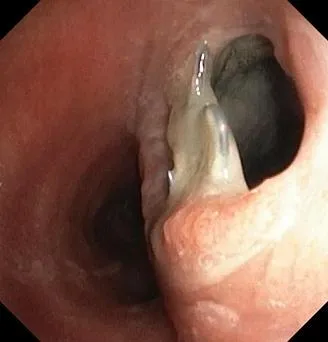 Трахеопищеводный свищ. Атлас эндоскопических изображений endoatlas