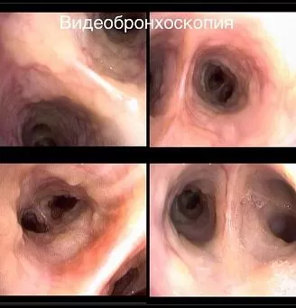Саркоидные бугорки в трахео-бронхиально дереве различной локализации. Атлас эндоскопических изображений endoatlas