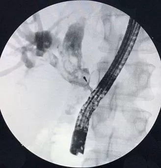 желчекаменная болезнь холедохолитиаз. холедохоэктазия. холедохолитиаз. мрт холангиография холедохолитиаз. холедохолитиаз проявления.