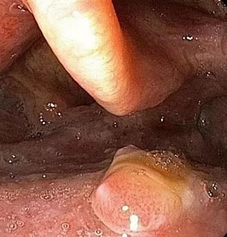 Плоскоклеточный рак ротоглотки. Атлас эндоскопических изображений endoatlas