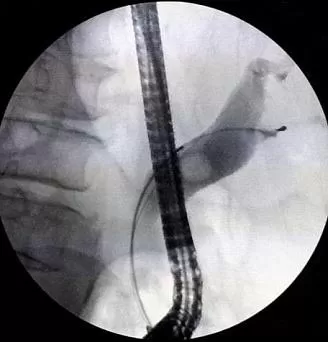 холедохолитиаз осложнения. обтурационный холедохолитиаз. холедохоэктазия. холедохолитиаз снимок. холедохолитиаз болевой синдром.