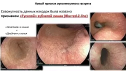 Новый эндоскопический признак аутоиммунного гастрита — «тусклая зубчатая линия» (Blurred Z-line)