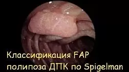 Классификация Шпигельмана (Spigelman, 1989) Оценка тяжести полипоза двенадцатиперстной кишки