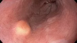 Эндоскопическая семиотика опухоли Абрикосова в пищеводе