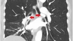 АСПИРАЦИЯ ТАБЛЕТКИ