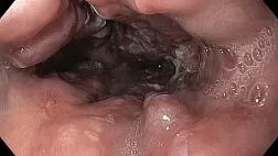 Варикозное расширение вен пищевода.