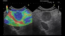 Эндоскопическая ультрасонография: эластография в оценке лимфатических узлов.