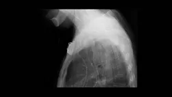 Клиническое применение расправляющихся металлических стентов в просвете желудочно-кишечного тракта