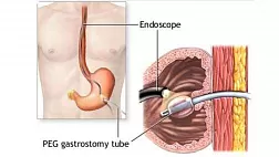 Памятка врачу ведение пациента с эндоскопической гастростомой