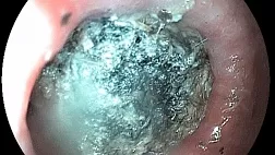 Безоар пищевода на фоне ахалазии кардии