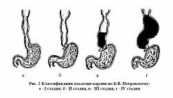 Ахалазия кардии